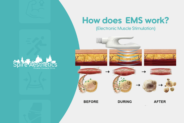 EMS treatment for post pregnancy weight loss treatment Alton