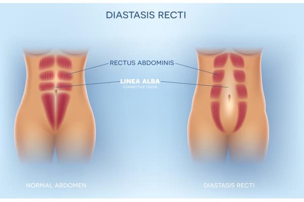 What Non-Surgical Options Are Available for Diastasis Recti Alton?