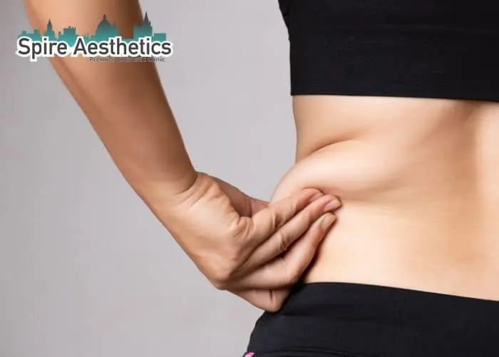 Image of woman pinching fat on their hips Alton. Fat Freezing treatment