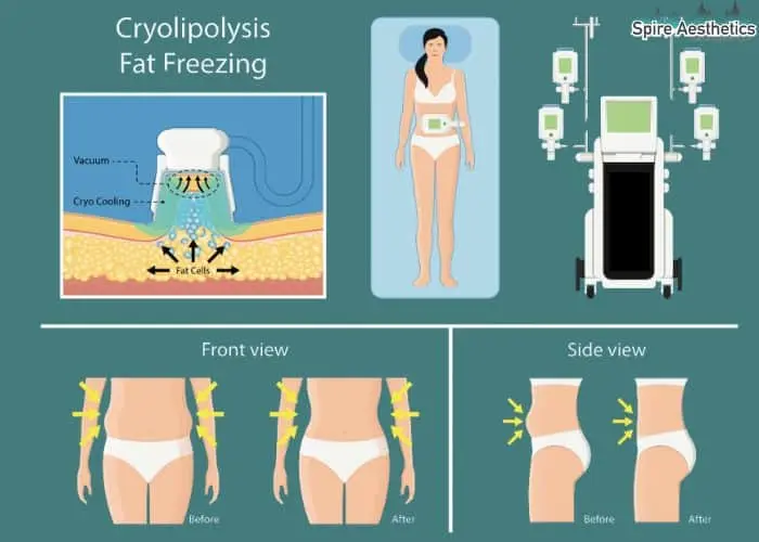 Fat freezing treatment Alton benefits for competitions to remove stubborn fat deposits.