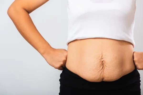 Image of a woman's stomach after weight loss with sagging skin following a gastric band Alton