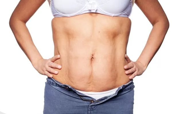 sagging skin on woman's stomach after weight loss injections Alton