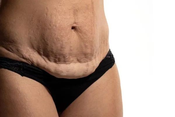 Image of womans stomach after weight loss injections Alton showing saggy skin
