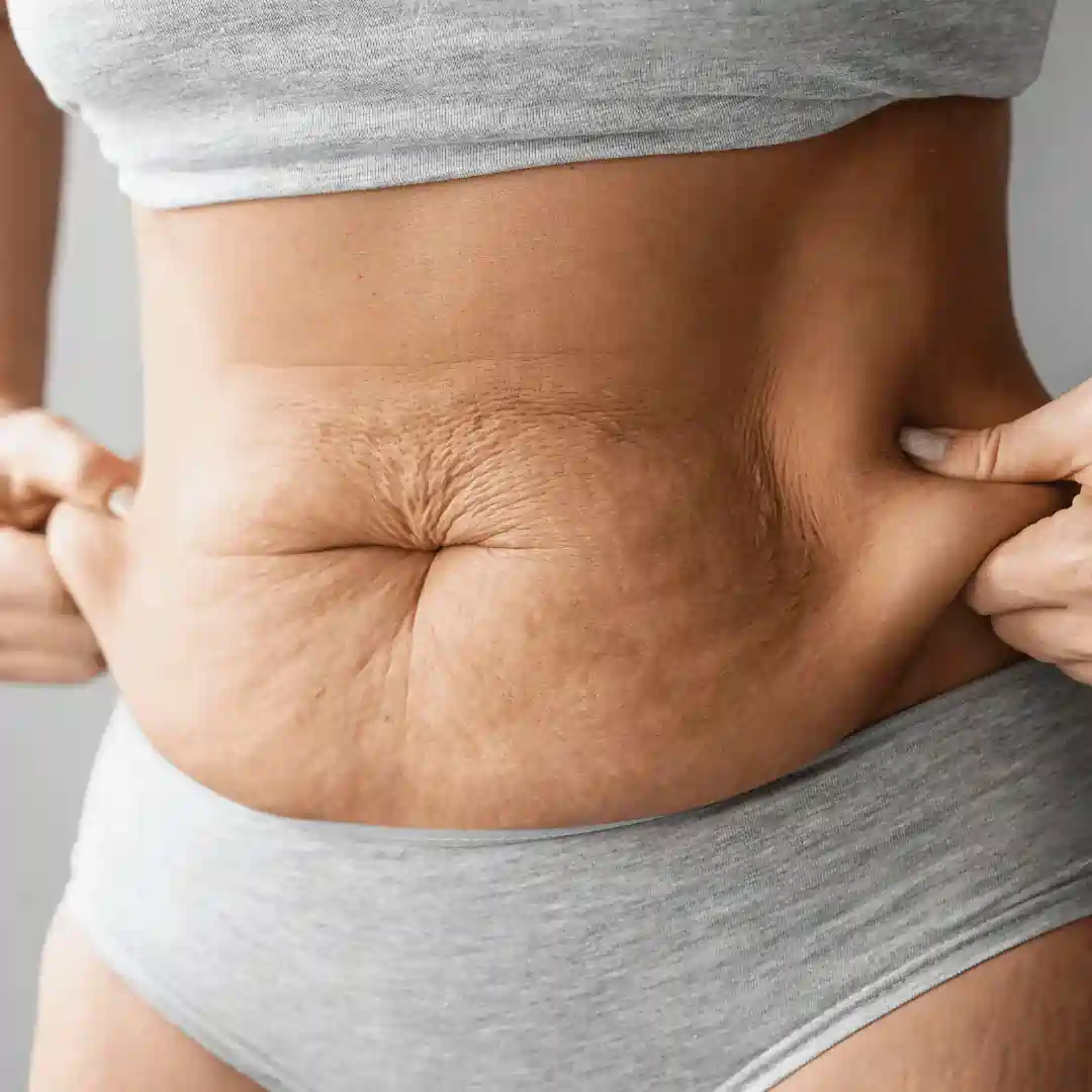 Is It Normal to Have Loose Skin After Pregnancy Alton?