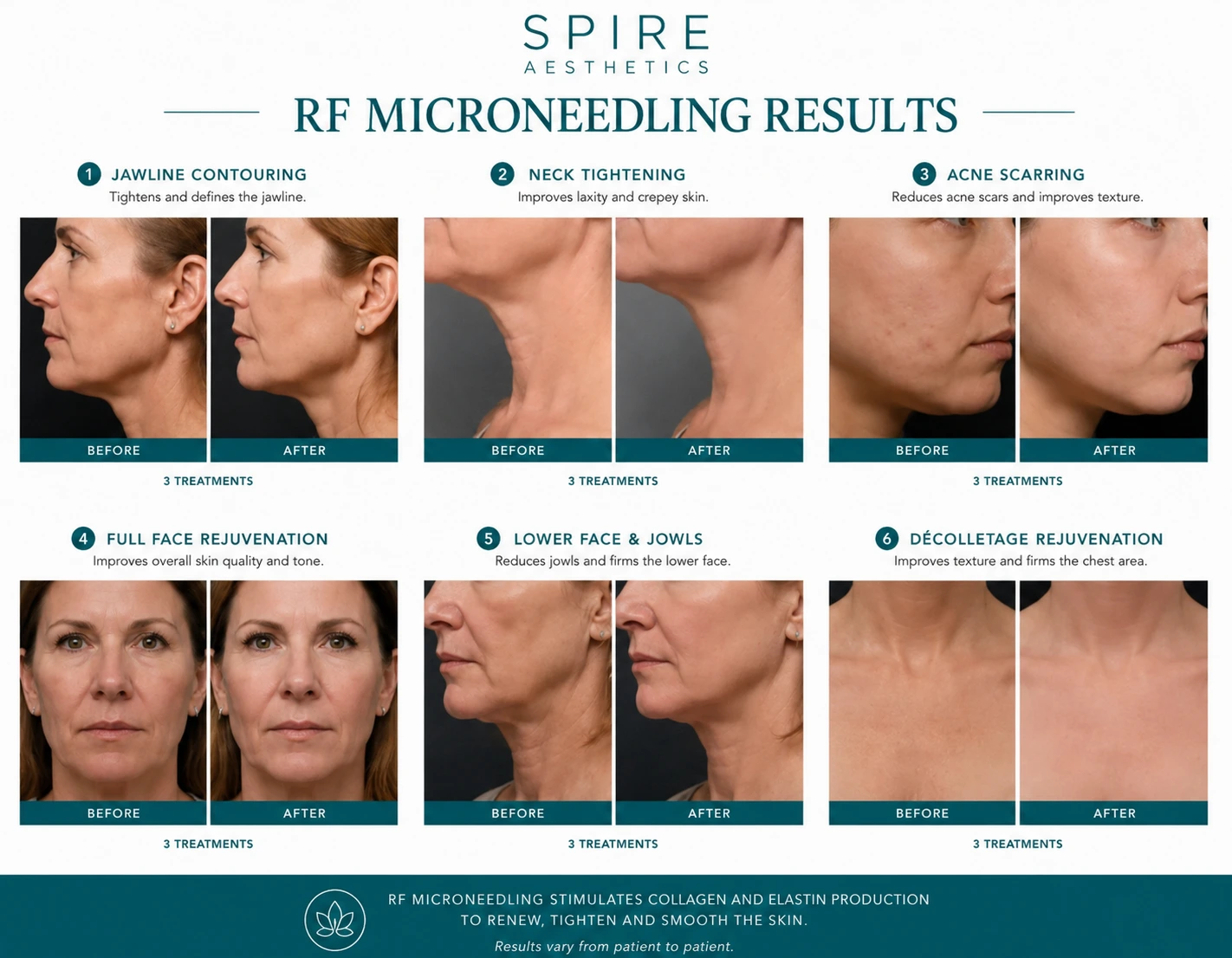 RF Microneedling Skin tightening Alton results