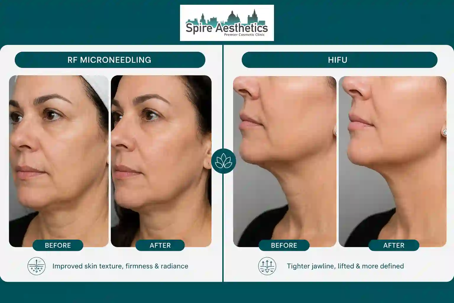 Can RF Microneedling and HIFU Be Combined Alton?