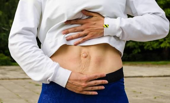 When Could Diastasis Recti Be the Missing Piece of the Puzzle Alton?