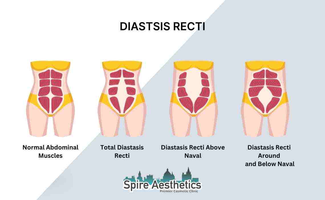 Is Non-Surgical Diastasis Recti Treatment Right for You? Common Concerns Answered Alton